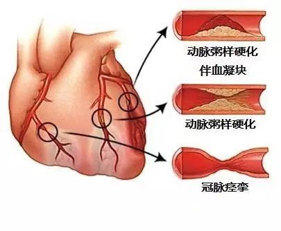 心血管疾病|心血管疾病图文详解！太珍贵了！看完全明白！