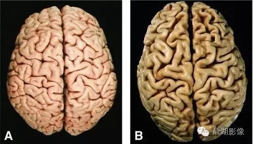 1-5-1-1-a~c)示:老年性皮質性腦萎縮,腦溝增大,蛛網膜下腔間隙增寬.