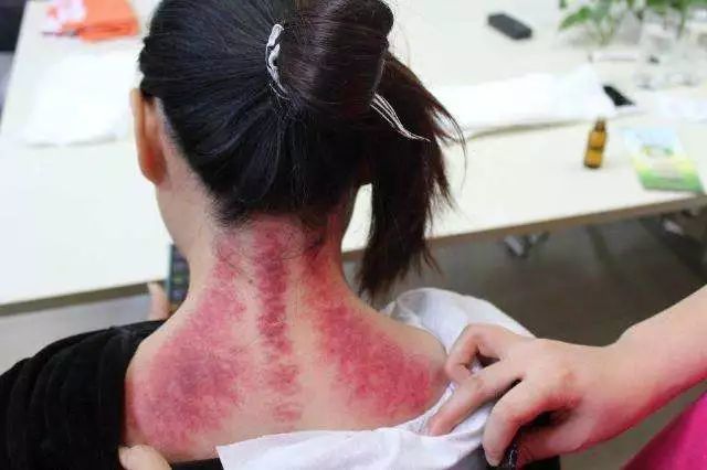 身体不好不是先补而是先排湿毒