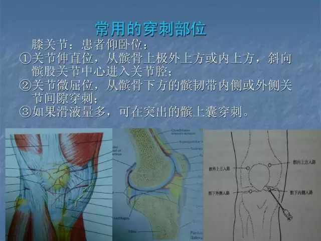 实用技术膝关节腔内注射治疗法