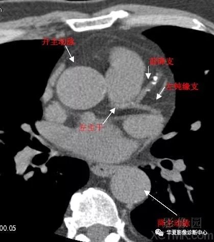 影像解剖心脏冠状动脉ct解剖中文详细标注图文