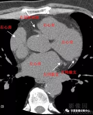 影像解剖|心脏冠状动脉ct解剖中文详细标注(图文)