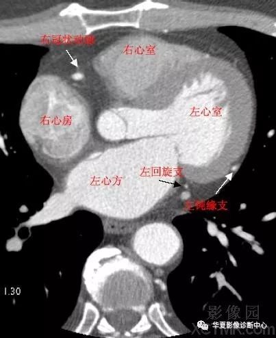 影像解剖心脏冠状动脉ct解剖中文详细标注图文