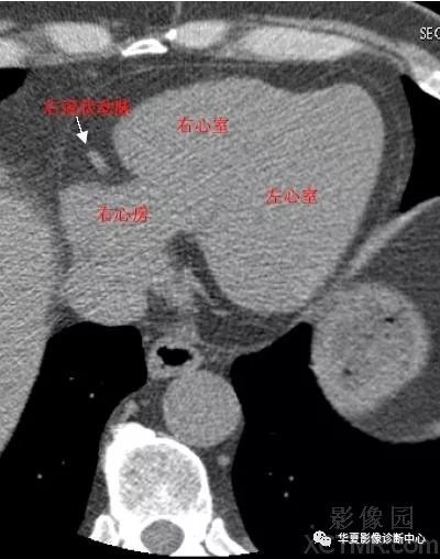 影像解剖心脏冠状动脉ct解剖中文详细标注图文