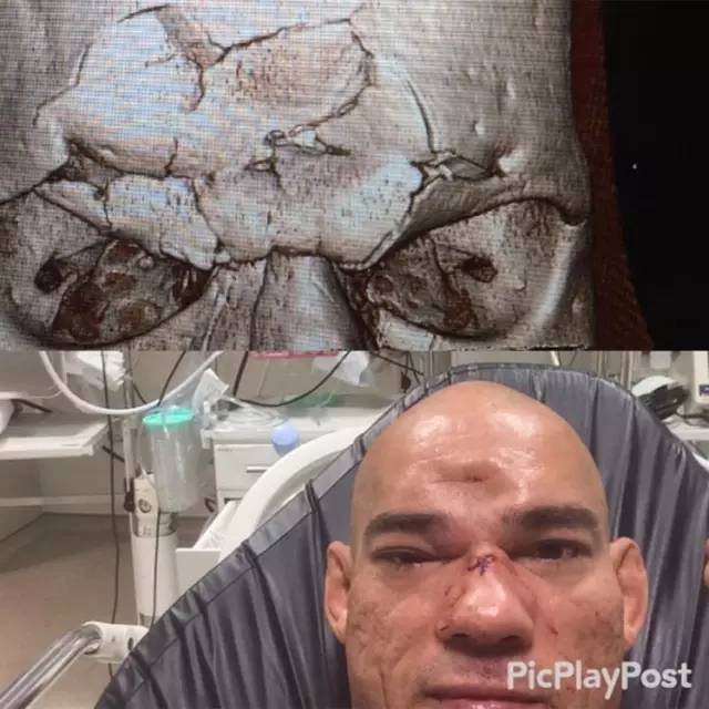 惊世飞膝撞碎对手头骨还有比这更狠的ko吗