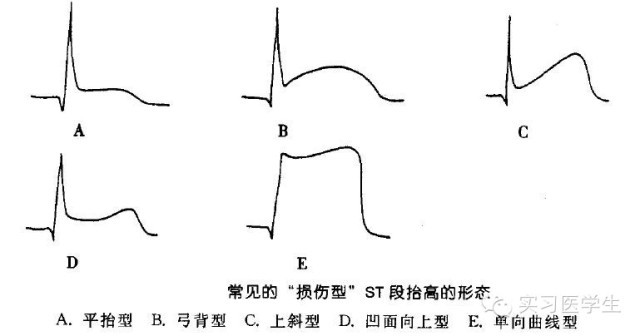 損傷:本側st段抬高qt間期延長再心外膜下心肌(透壁性),本側t波倒置