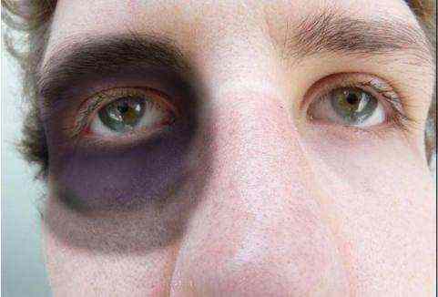 首先黑眼圈可能是肾脏性能不好