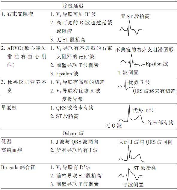 心电图8+2现象诊断标准图片