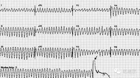 (2)心电图表现:心室扑动呈正弦波图型,波幅大而规则,频率150~300次