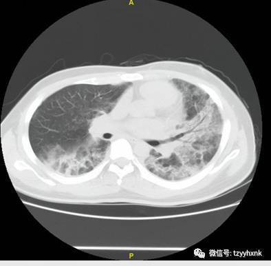 一例HIV抗体阴性的艾滋病合并肺孢子菌肺炎确