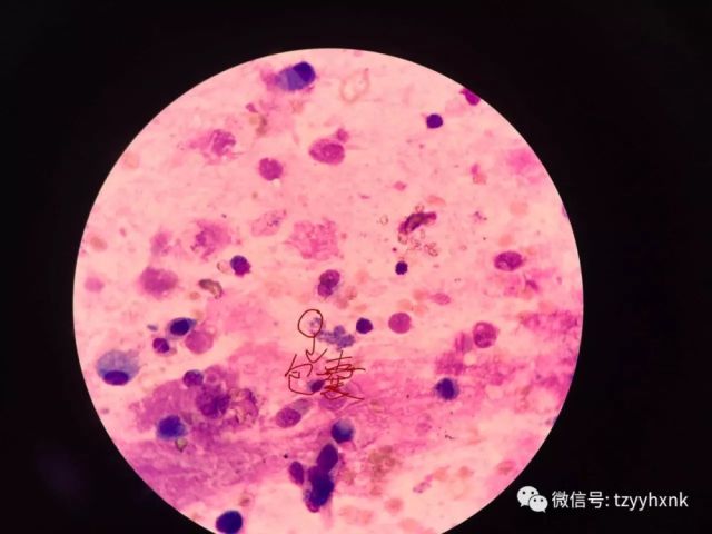 一例HIV抗体阴性的艾滋病合并肺孢子菌肺炎确