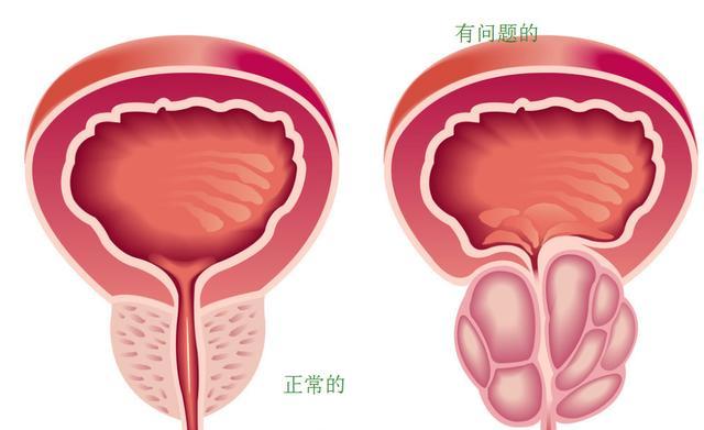 正确认识前列腺钙化,8种药材一起煮,常喝前列