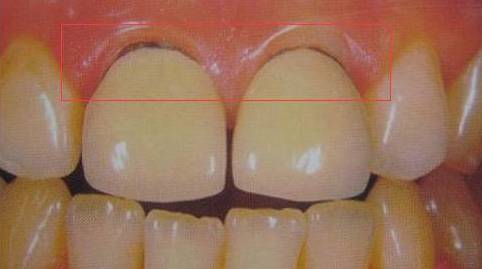 全瓷牙牙龈萎缩实物图图片