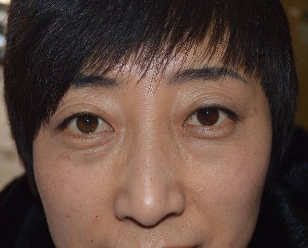 40岁的女人眼袋肿大 用家里的 它 贴一贴 消除眼袋淡化斑点