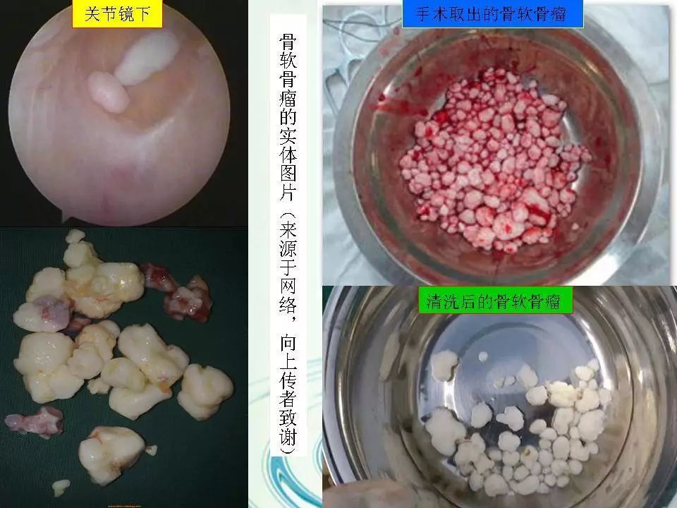 的真面目收集我院近10年来经影像诊断或手术确诊的滑膜骨软骨瘤病病例