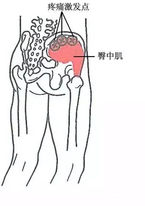 此壓痛點處於髂前上棘後1.5～2寸.