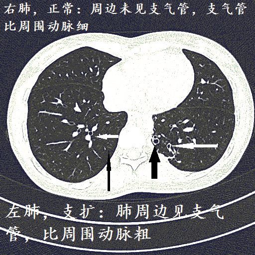 经典图谱详细解说支气管扩张ct小诀窍学不会我拜你为师