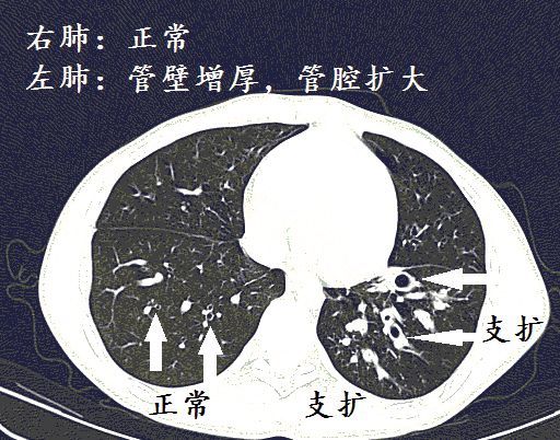 经典图谱详细解说支气管扩张ct小诀窍学不会我拜你为师