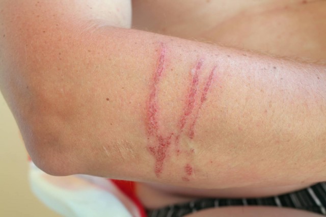 疤痕体质应该怎样治疗告诉你有关小知识