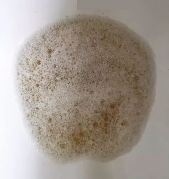 尿毒症,从名字就可得知,如果不小心患了,尿液肯定会有变化.