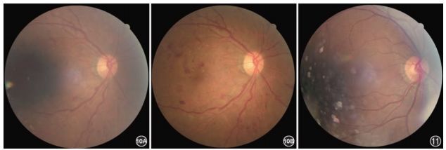 示眼底圖像黃斑區暗影,鼻側黃色邊緣,圖像質量未達標;10b 示散大瞳孔