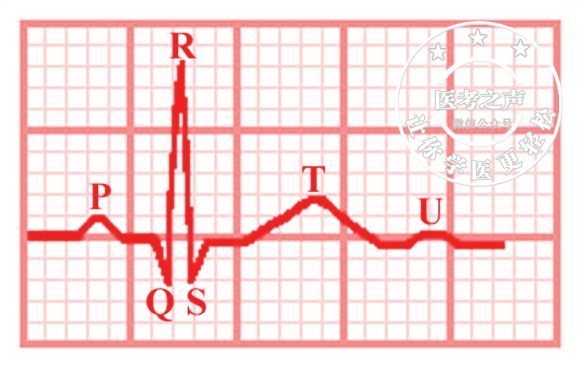 (正常心電圖波形)缺血型心電圖改變心內膜下心肌缺血特點:t波高聳心電