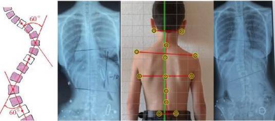 儿童脊柱侧弯30度照片图片