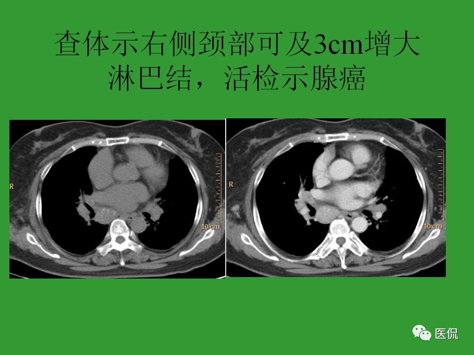 30个病例一次搞懂纵隔淋巴结肿大的诊断和鉴别诊断