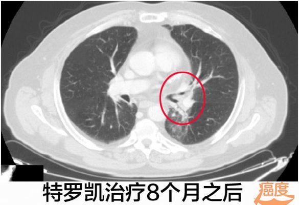 :化疗失败的EGFR阴性肺腺癌使用特罗凯病灶完