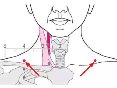 【解剖位置 在锁骨上窝之中点,有颈阔肌,肩胛舌骨肌;上方有颈横