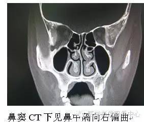 鼻中隔偏曲的影像学表现