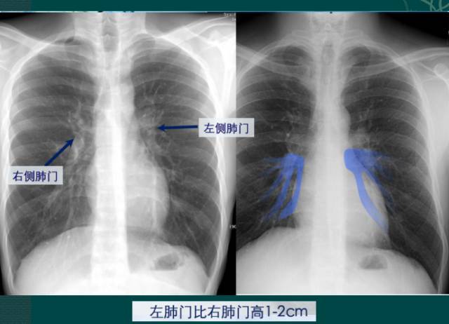 讀完此文終於學會看胸片了