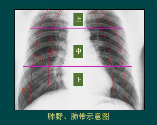 肺野分区图片