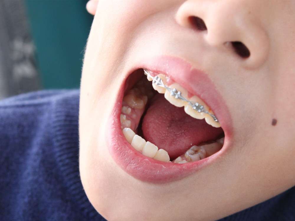 孩子牙齿腐蚀,家长先别忙着责备孩子,只怪你太