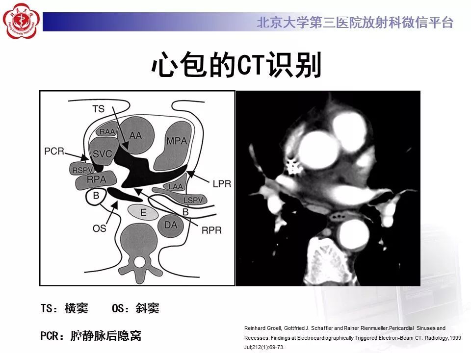 心包竇及心包隱窩的解剖結構內附ct斷層圖解