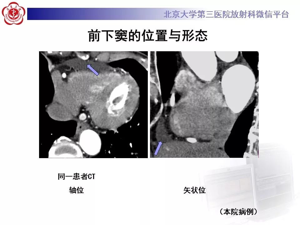 心包竇及心包隱窩的解剖結構內附ct斷層圖解