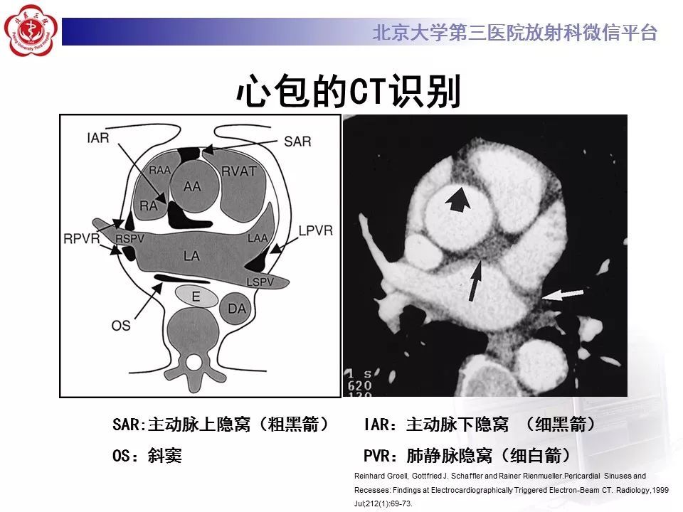 心包竇及心包隱窩的解剖結構內附ct斷層圖解