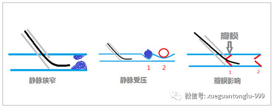 中心静脉穿刺:教科书上没有的穿刺经验!