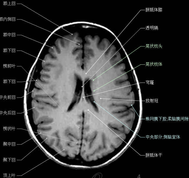 顱腦斷層解剖頭顱mr軸位解剖圖彩色標註版