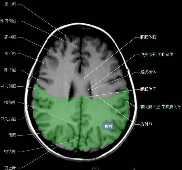 颅脑断层解剖头颅mr轴位解剖图彩色标注版