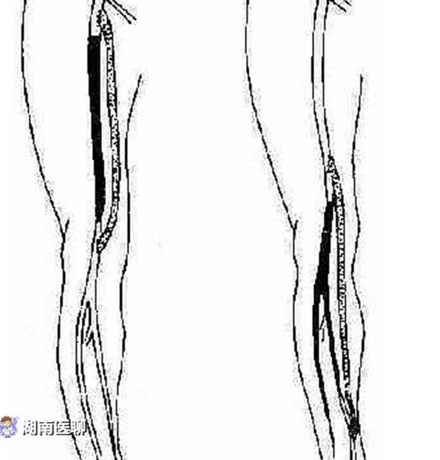 益阳一老人腿痛发凉半年后下肢动脉硬化无奈截肢