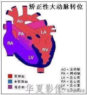 诊断,与完全性大动脉错位一样,纠正性大动脉错位的诊断也需要判断心房