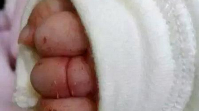 一根头发丝差点让一东莞婴儿失去手指