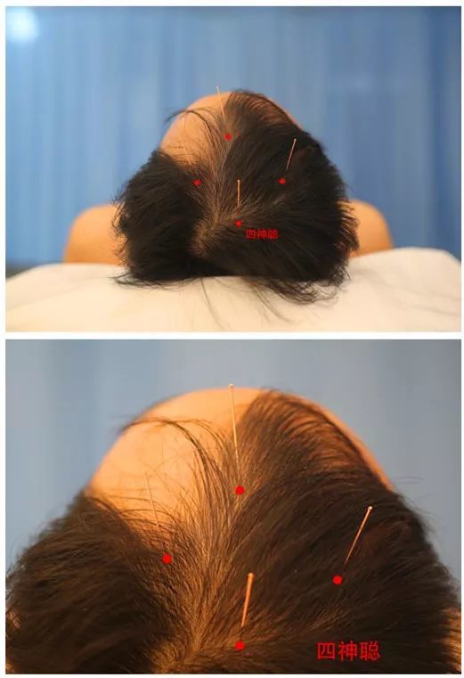 图1-1四神聪操作图1-2神门操作神门在中应人,中刺至人部,直刺0.3～0.