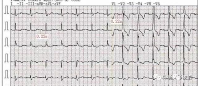7种经典t波倒置详解