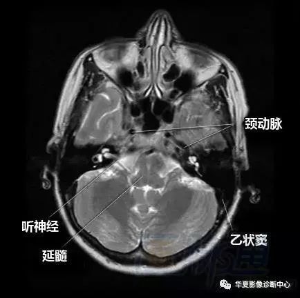 腦部斷層 內囊 willis環 前聯合 垂體 海馬:清晰解剖圖譜