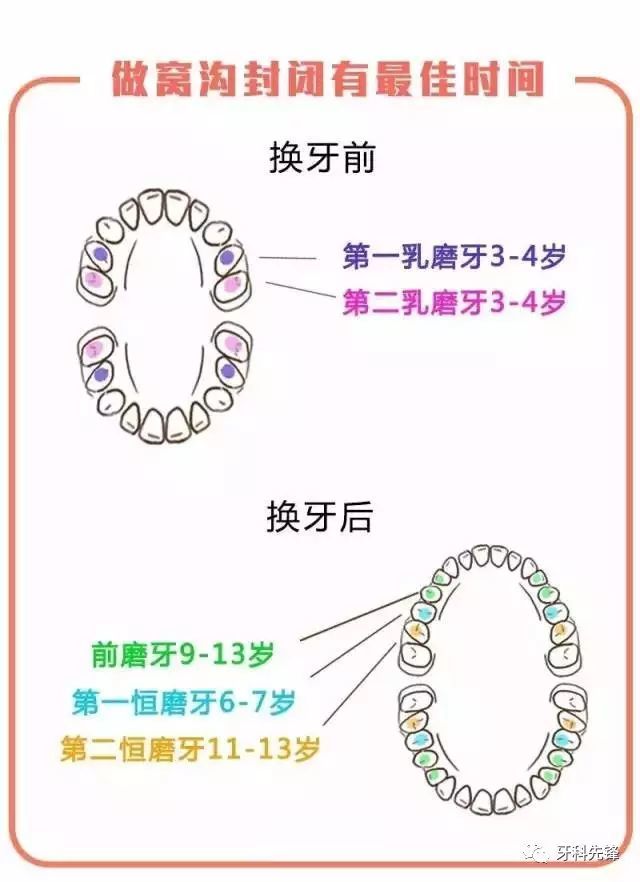 窝沟封闭几岁做最合适做一颗牙多少钱