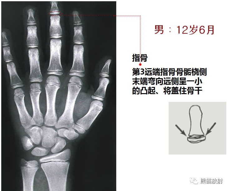 儿童生长发育骨龄图谱