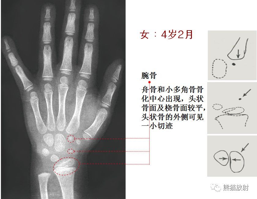 儿童生长发育骨龄图谱