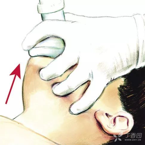 气管插管技术及医护配合_腾讯新闻